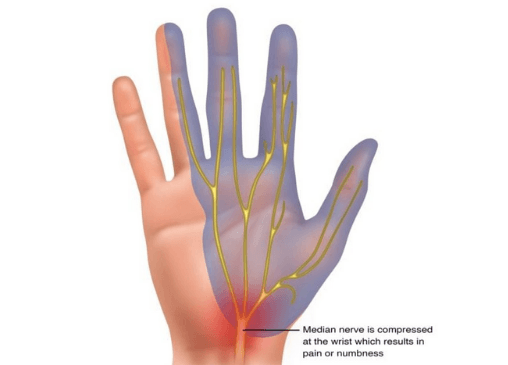 Carpal Tunnel Syndrome