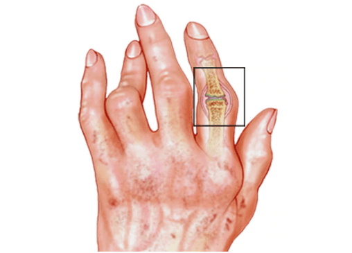 Rheumatoid Arthritis